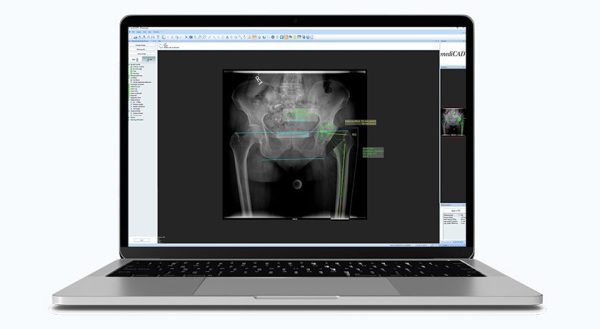mediCAD 8 Orthopedic & Trauma Planning Platform