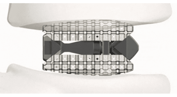 Xenix Medical Lux Expandable Lumbar Interbody Fusion