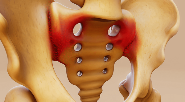 PainTEQ Announces First Patient Enrolled in the TRAQTION Study