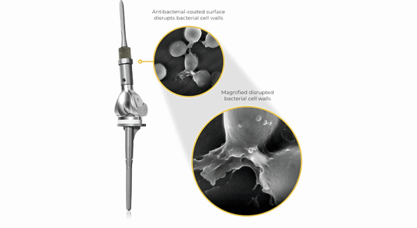 Onkos Surgical ELEOS implants with NanoCept